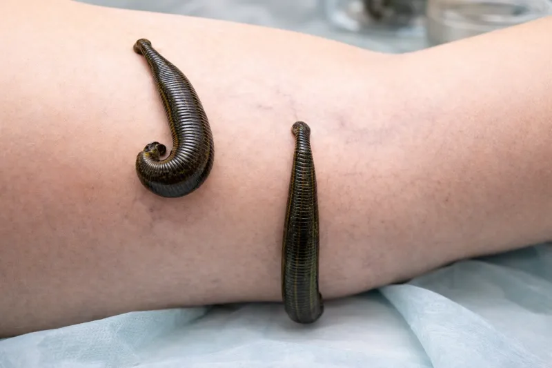 Blutegel auf dem Bein eines Patienten