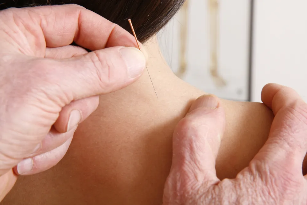 Patient bei der Akupunkturbehandlung